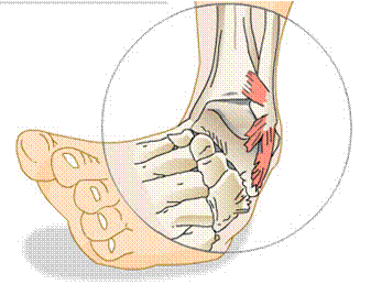 Ankle Sprain Ligament