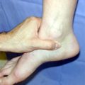 Ankle Synovitis: Understanding and Treating The Problem