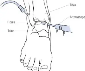 Ankle Arthroscopy Surgery And Recovery