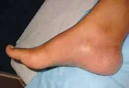 inside ankle pain