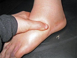 Ankle Edema