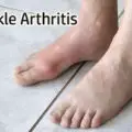 Arthritis In Ankle: Causes Symptoms and Treatment Options