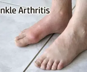 Arthritis In Ankle: Causes Symptoms and Treatment Options