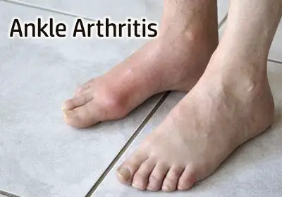 ankle arthritis