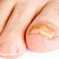 What Causes Yellow Toenail Fungus? How to Get Rid of It?