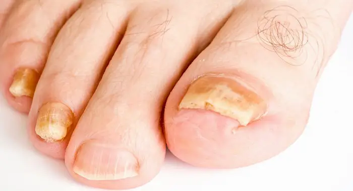 What Causes Toenail Fungus